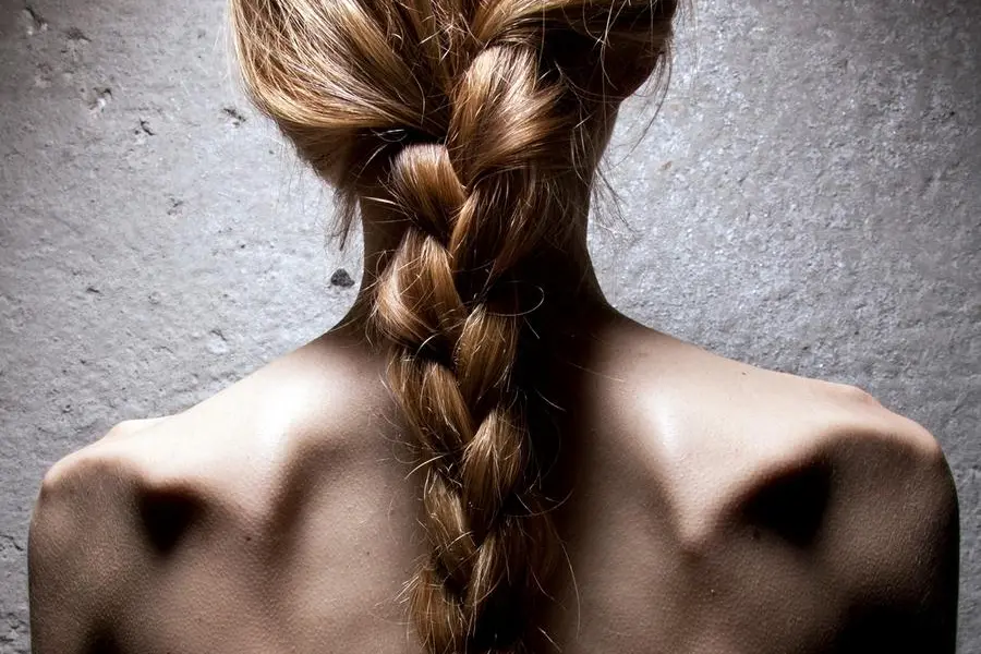 A girl suffering from anorexia on January 10, 2009, in Warsaw. Photo CTK/Grzegorz Klatka. (CTK via AP Images)