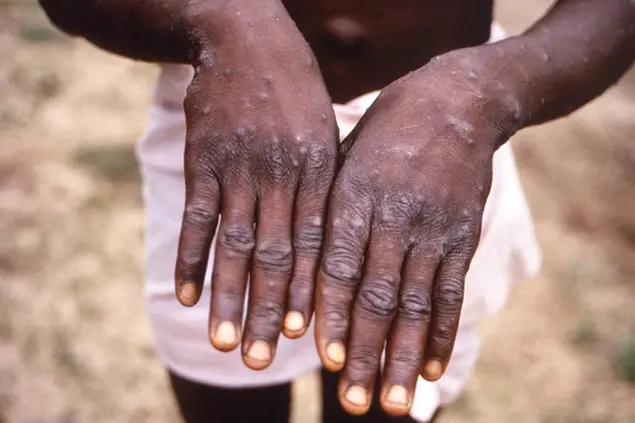 Foto CDC – Yvan J.F. Hutin, et al. Outbreak of Human Monkeypox, Democratic Republic of Congo, 1996 to 1997. Emerging Infectious Diseases Journal, Vol. 7, No. 3, May – June, 2001 (via Ap)